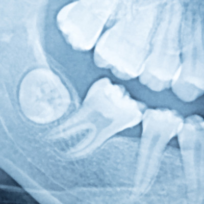 Cirugía oral y Maxilofacial